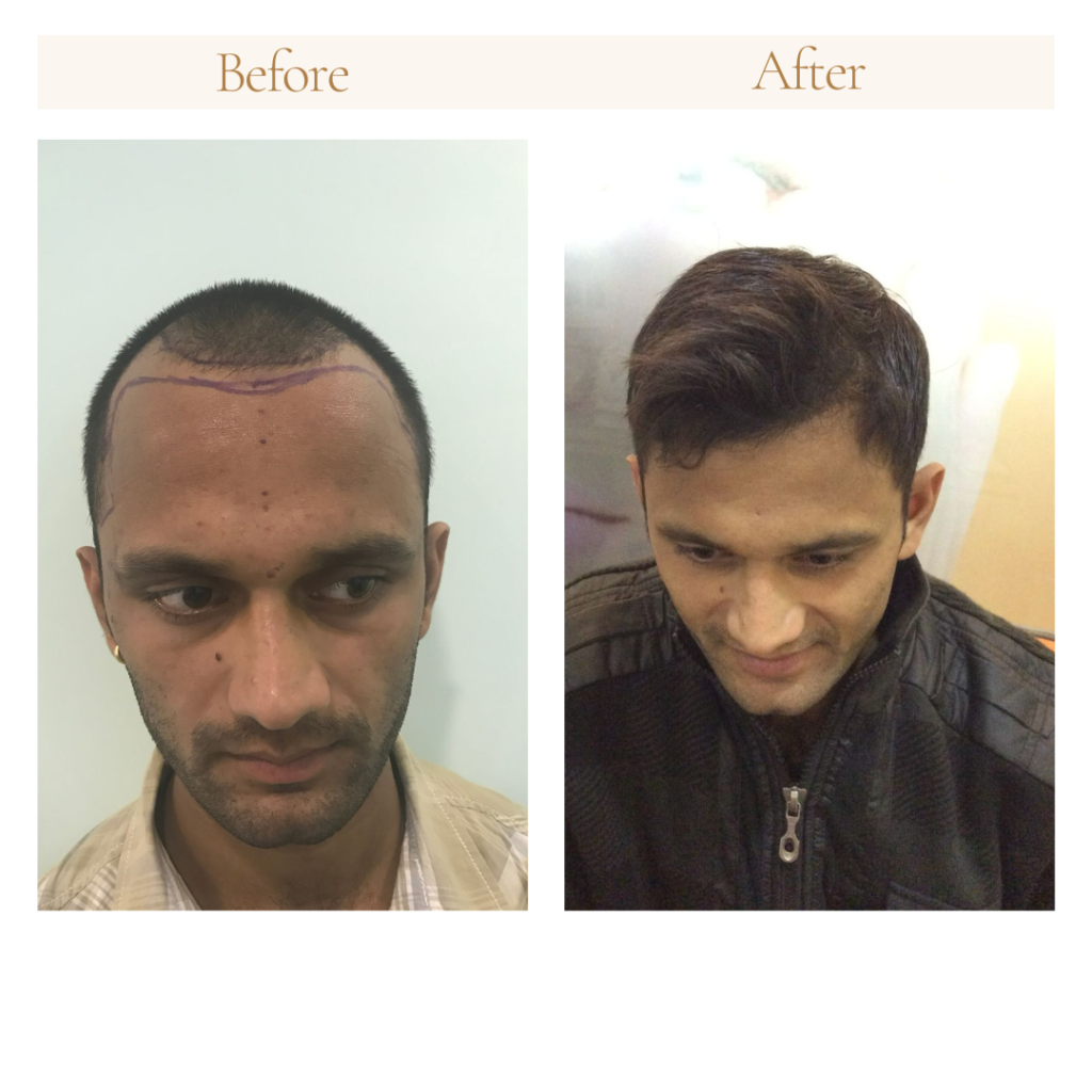 realistic hair transplant results before after FUE Delhi Renaissance Clinic