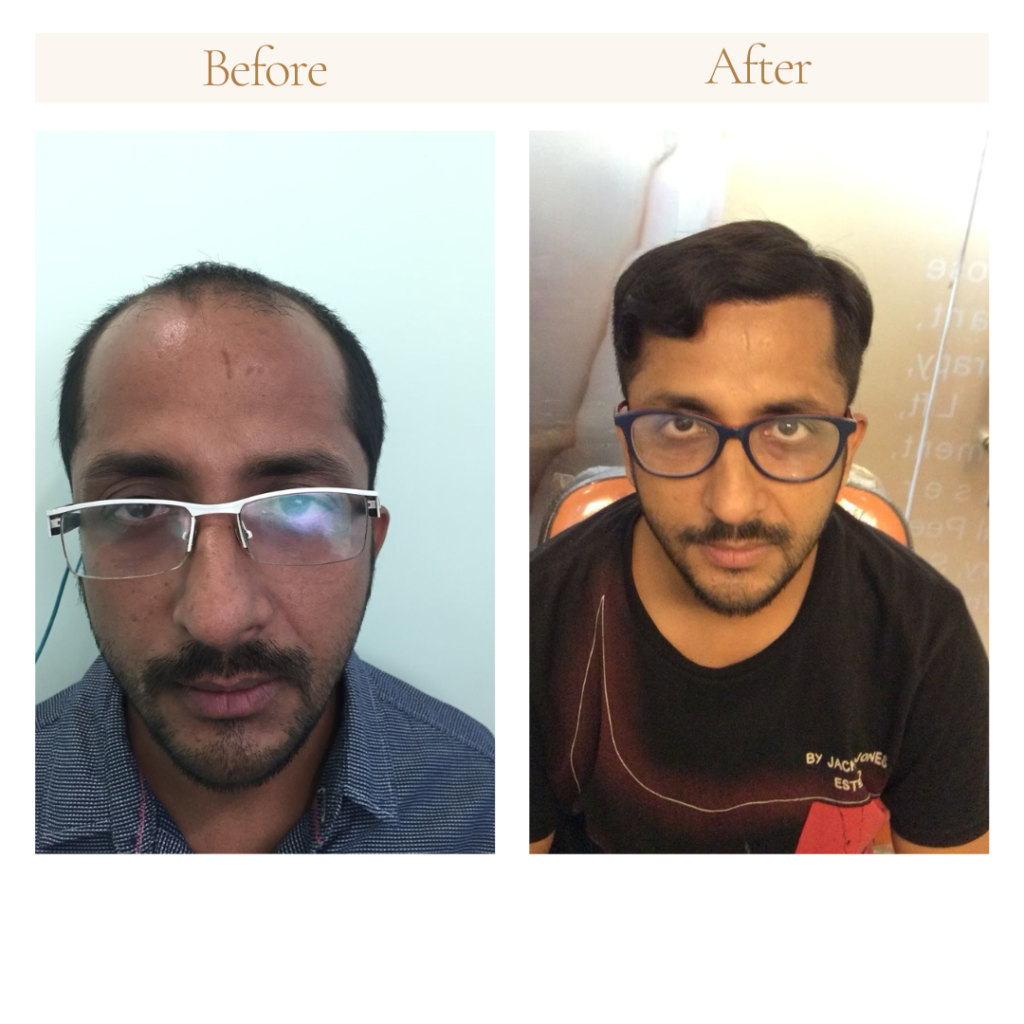 hair transplant before after results Norwood 3 Delhi NCR 2026