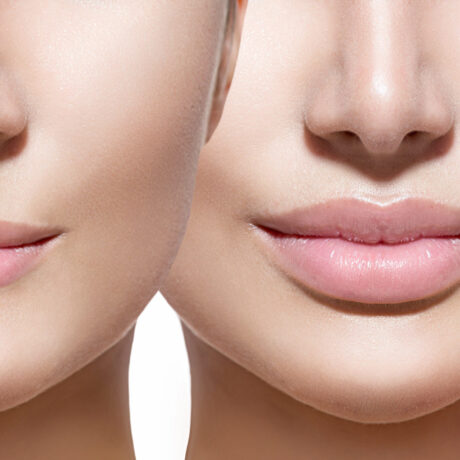 Lip Surgery