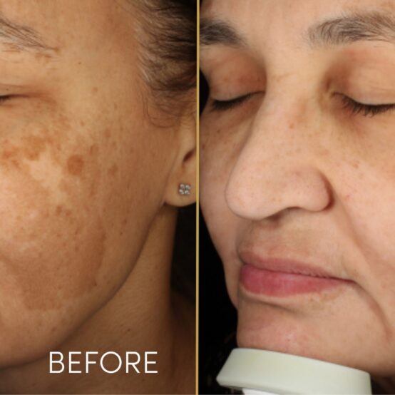 Pigmentation Treatments