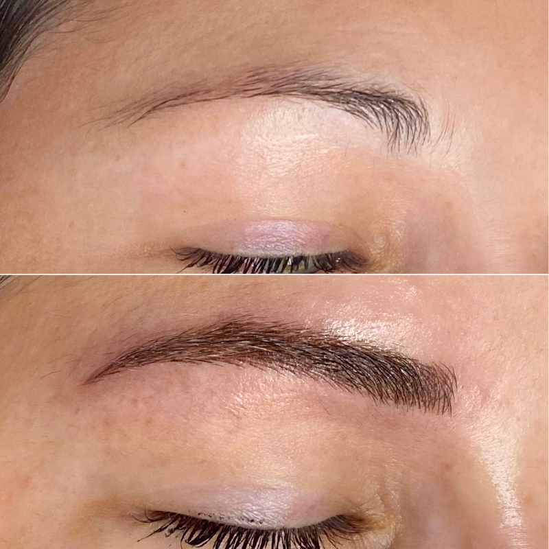 Eyebrow Transplant