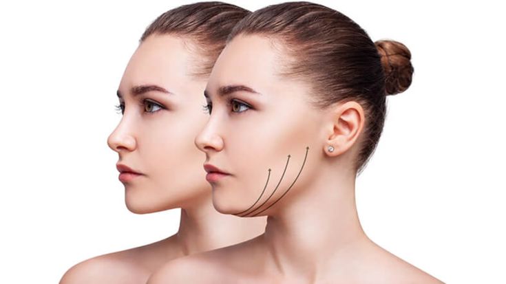 Facelift Surgery