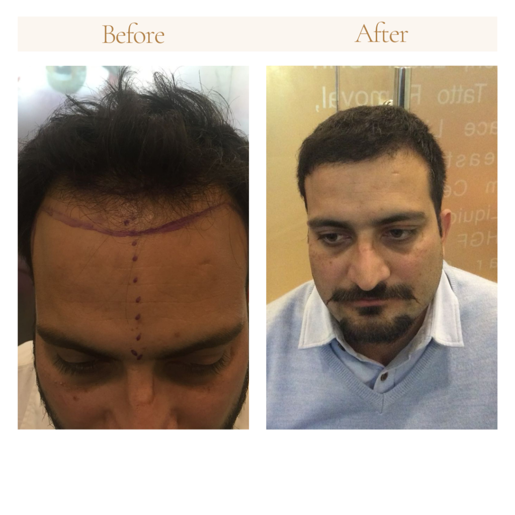 neutral before and after instagram post