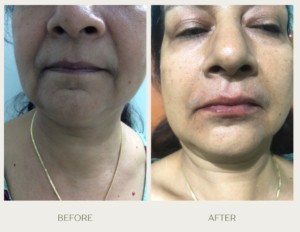 green gentle before and after instagram post (1)