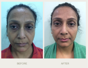 green gentle before and after instagram post (2)