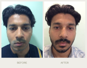 green gentle before and after instagram post (3)