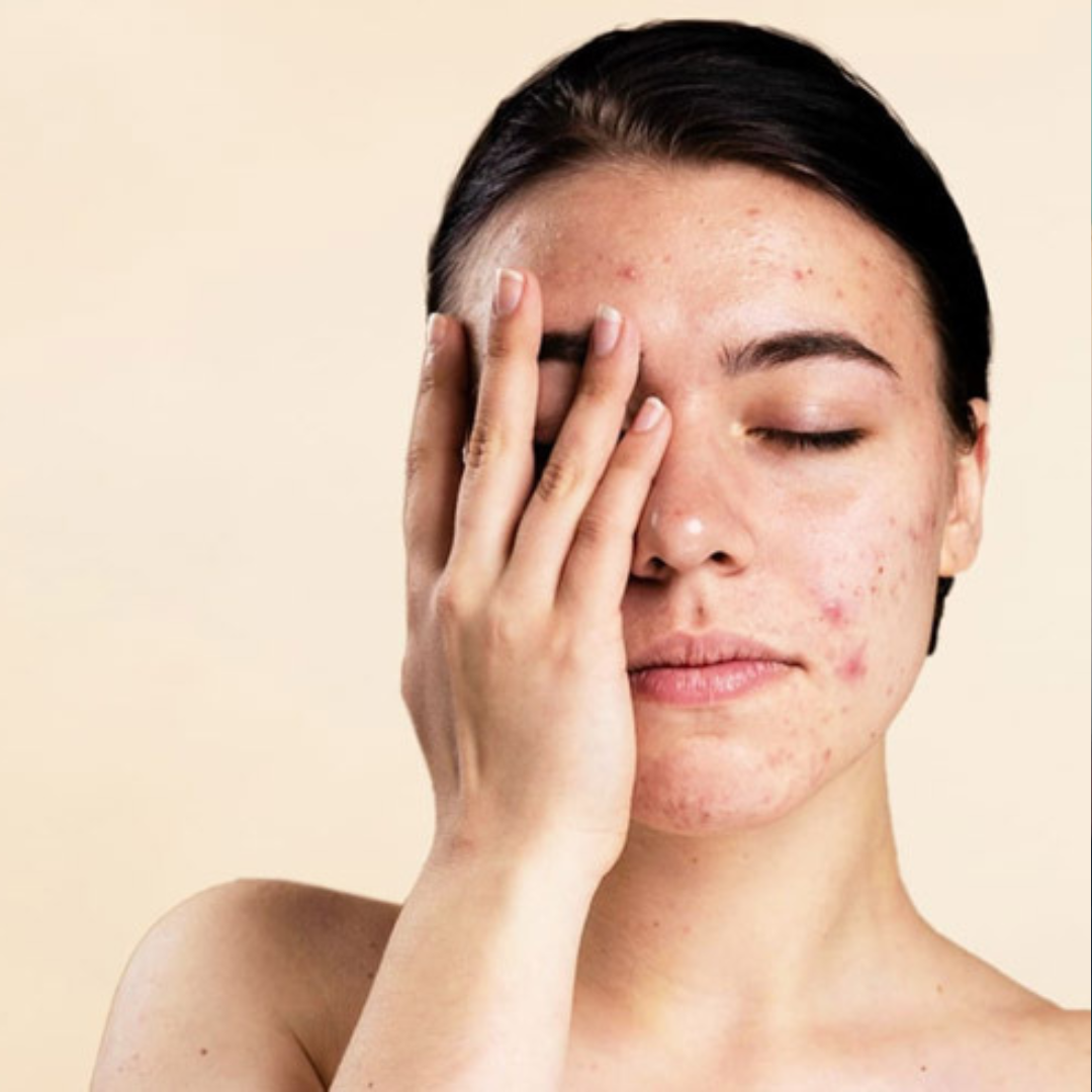 Acne Scar Treatment in India at Renaissance Clinic