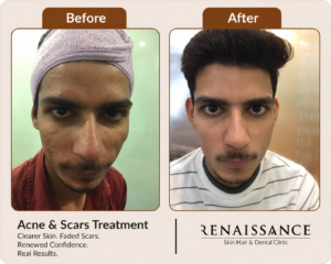 before and after acne and acne scar treatment with clearer skin and visibly reduced acne marks. at renaissance clinic