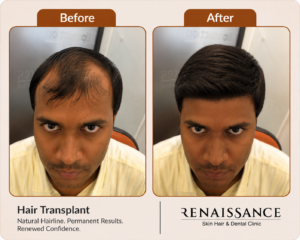 before and after hair transplant results showing natural hairline restoration at renaissance clinic india