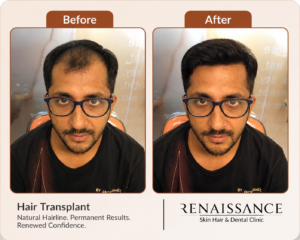 before and after hair transplant results showing natural hairline restoration at renaissance clinic india, ghaziabad.