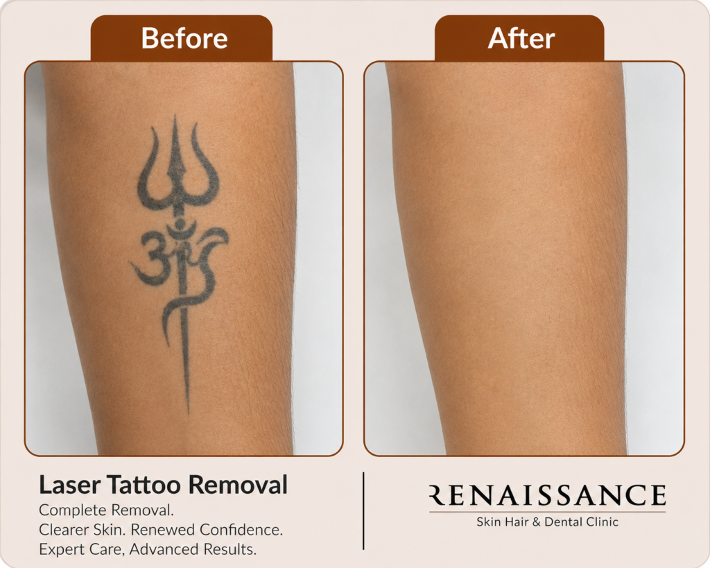Before and after laser tattoo removal results at the best tattoo removal clinic in Ghaziabad showing visible tattoo fading after advanced laser treatment.