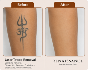 Before and after laser tattoo removal results at the best tattoo removal clinic in Ghaziabad showing visible tattoo fading after advanced laser treatment.