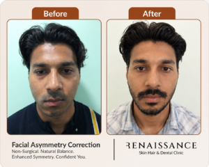 before and after non surgical facial asymmetry correction with improved facial balance and symmetry.