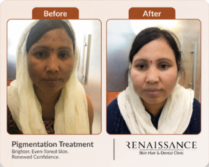 before and after pigmentation treatment showing reduced dark spots and more even skin tone.