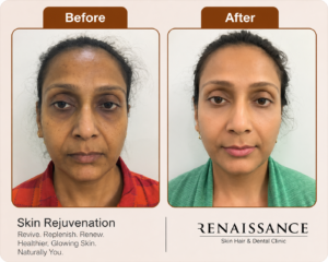 before and after skin rejuvenation treatment showing brighter, smoother, and healthier looking skin. at renaissance clinic