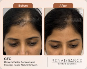 female hair loss treated by gfc treatment at renaissance clinic