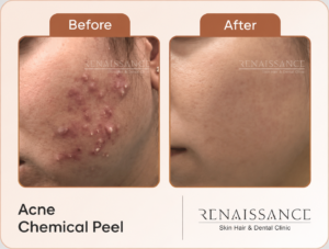 acne treatment from chemical peel from renaissance clinic