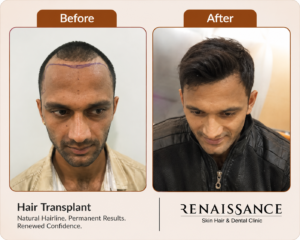 hair transplant results showing natural hairline restoration at renaissance clinic india, ghaziabad.