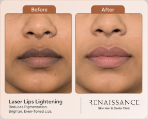 laser lip lighting treatment at renaissance clinic